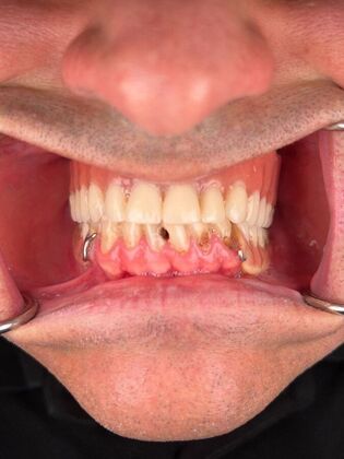All on 4 Dental Implants: Case 27 - Before