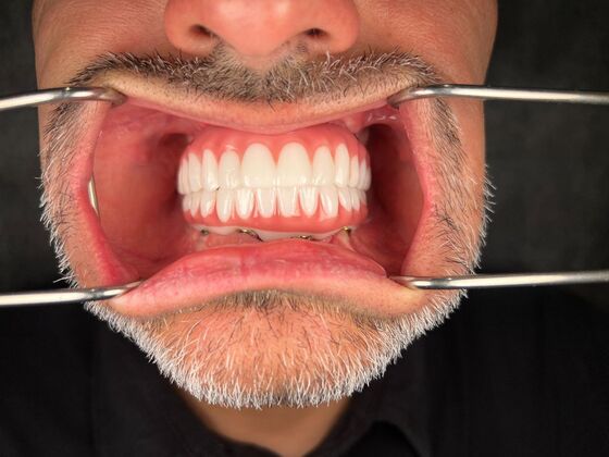 All on 4 Dental Implants: Case 27 - After
