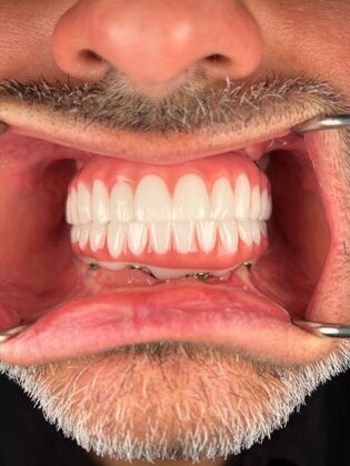 All on 4 Dental Implants: Case 27 - Before