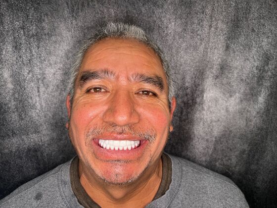 All on 4 Dental Implants: Case 28 - After