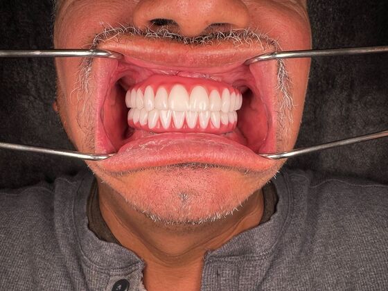 All on 4 Dental Implants: Case 28 - After