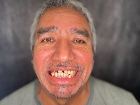 All on 4 Dental Implants: Case 28 - Before
