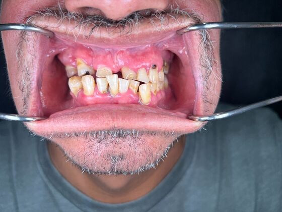 All on 4 Dental Implants: Case 28 - Before