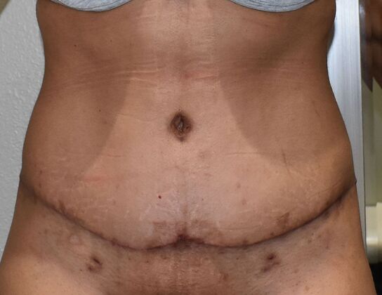 Tummy Tuck (Abdominoplasty) Case 606 - After