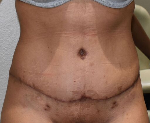 Tummy Tuck (Abdominoplasty): Case 606 - After