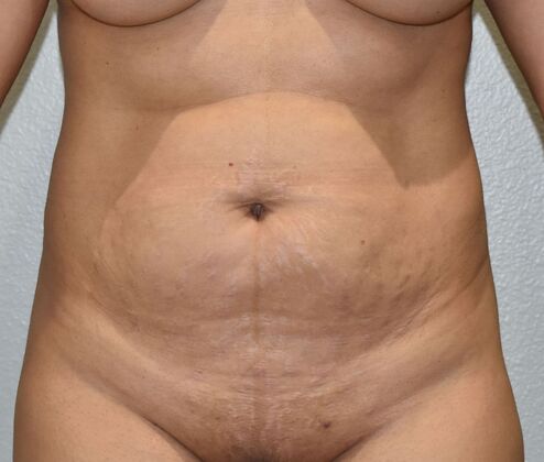 Tummy Tuck (Abdominoplasty) Case 606 - Before