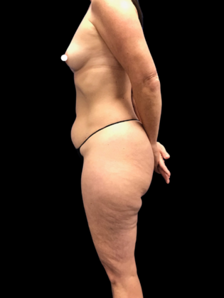 Tummy Tuck Tummy Tuck 6 - Before