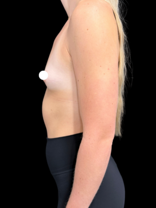 Breast Augmentation: Breast Augmentation 1 - Before