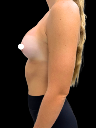 Breast Augmentation: Breast Augmentation 1 - After