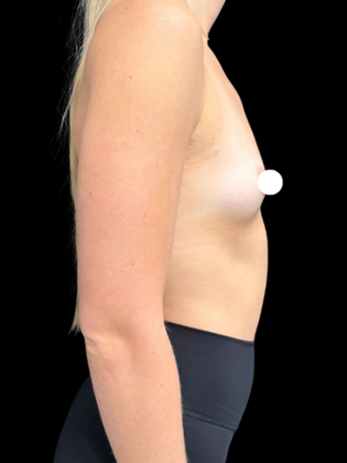 Breast Augmentation: Breast Augmentation 1 - Before