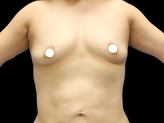 Breast Augmentation Breast Augmentation 7 - Before