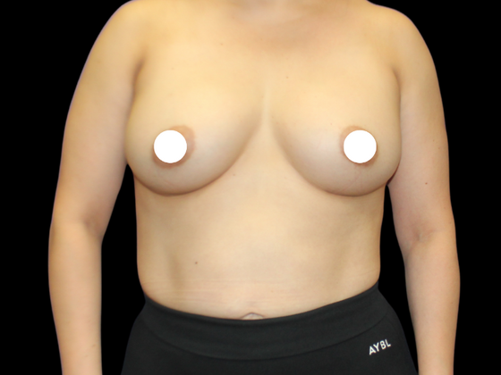 Breast Augmentation Breast Augmentation 7 - After