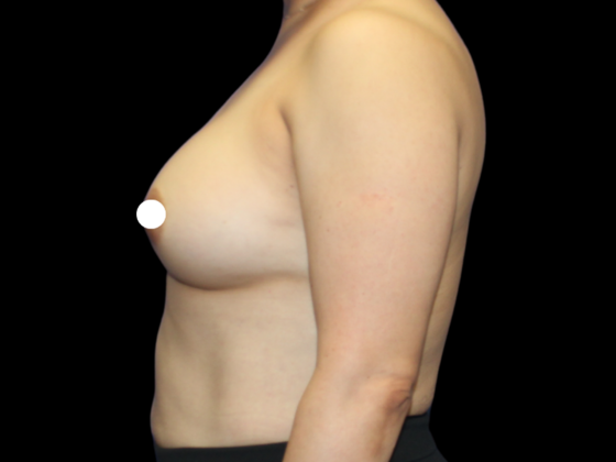 Breast Augmentation: Breast Augmentation 7 - After