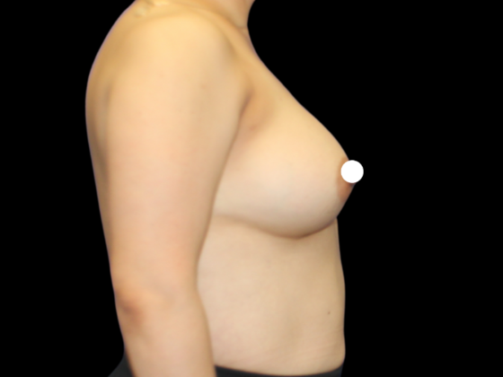 Breast Augmentation: Breast Augmentation 7 - After