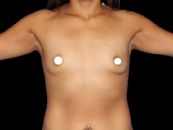 Breast Augmentation Breast Augmentation 8 - Before