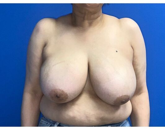 Breast Reduction Case 18 - Before