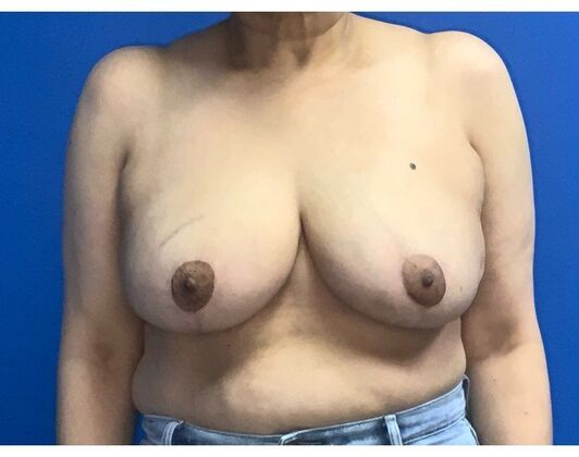 Breast Reduction Case 18 - After