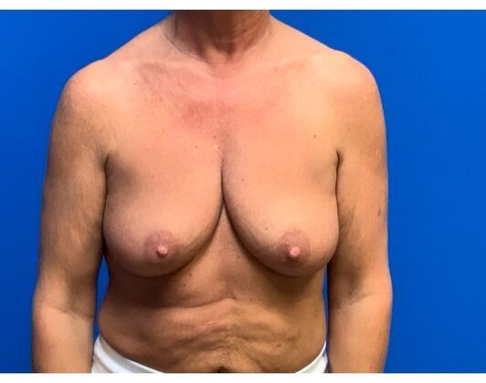 Mastopexy Case 23 - Before