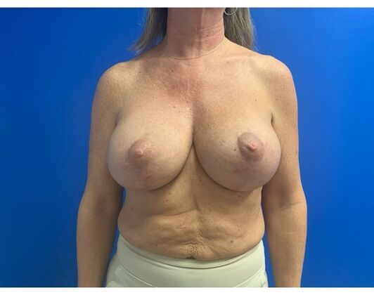 Mastopexy Case 23 - After