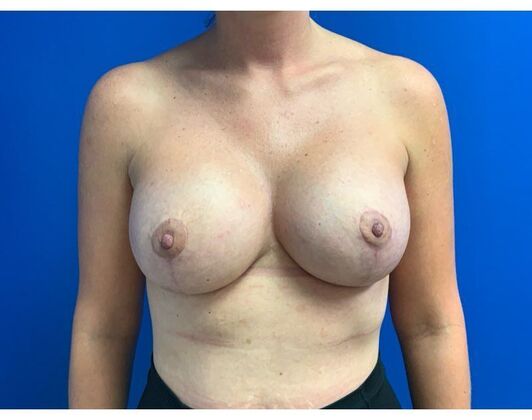 Mastopexy Case 24 - After