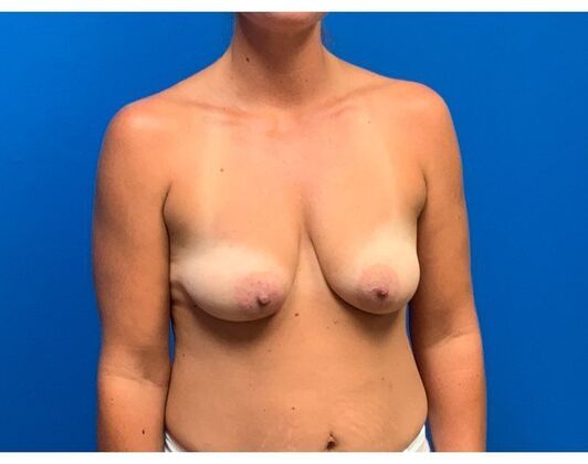 Mastopexy Case 25 - Before