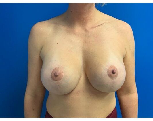 Mastopexy Case 25 - After