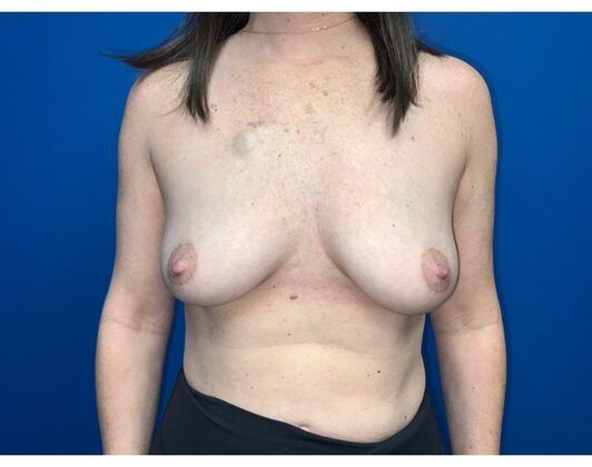 Breast Reconstruction Case 16 - Before