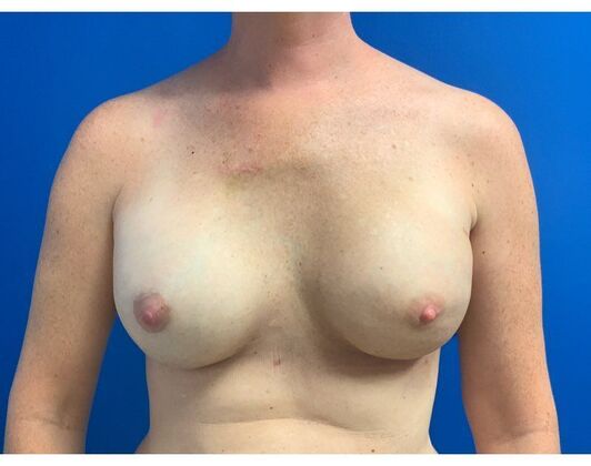 Breast Reconstruction Case 16 - After