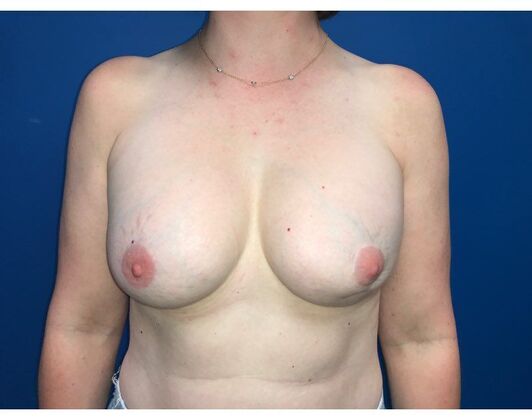 Breast Reconstruction Case 17 - Before