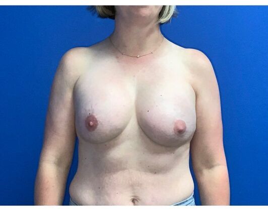 Breast Reconstruction Case 17 - After