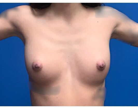 Breast Augmentation Case 40 - Before