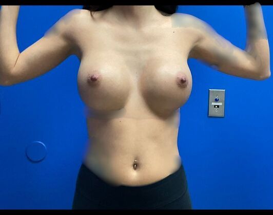 Breast Augmentation Case 40 - After