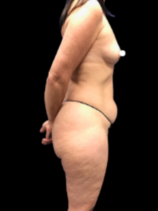 Breast Augmentation: Breast Augmentation 5 - Before