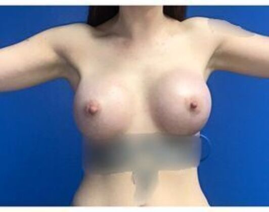 Breast Augmentation Case 36 - After