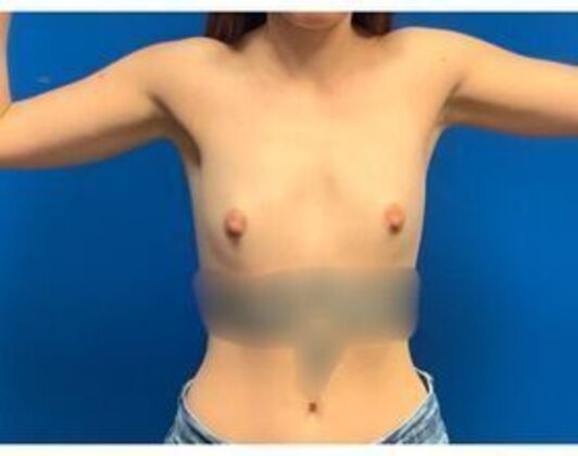 Breast Augmentation Case 36 - Before