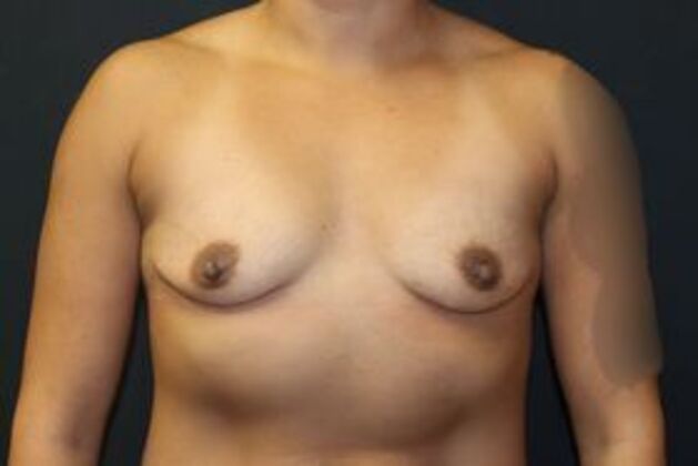 Breast Augmentation Case 13 - Before