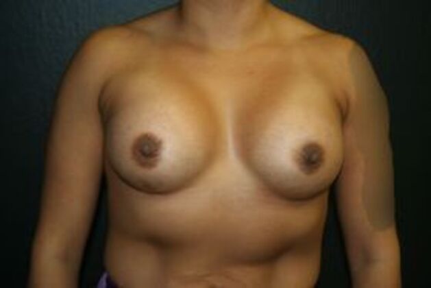 Breast Augmentation Case 13 - After