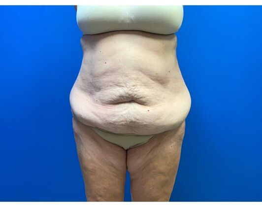 Abdominoplasty Case 40 - Before