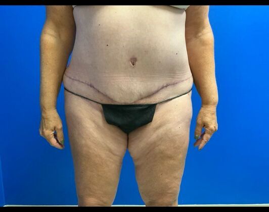 Abdominoplasty Case 40 - After