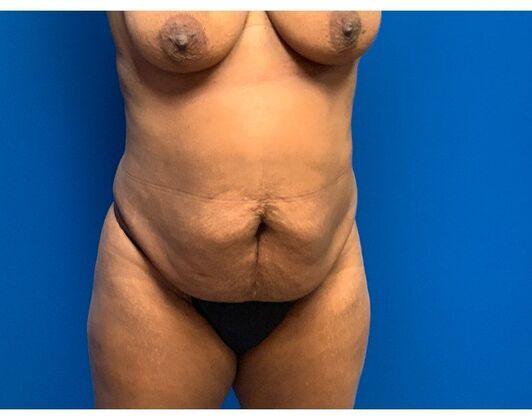 Abdominoplasty Case 41 - Before