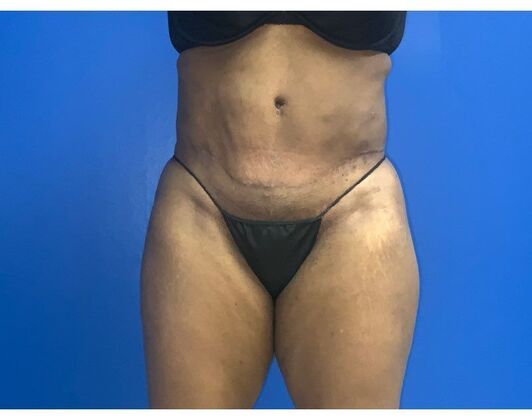 Abdominoplasty Case 41 - After