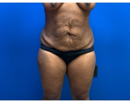 Abdominoplasty Case 42 - Before