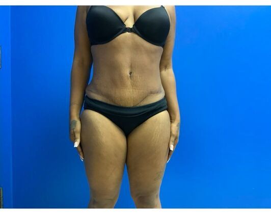 Abdominoplasty Case 42 - After