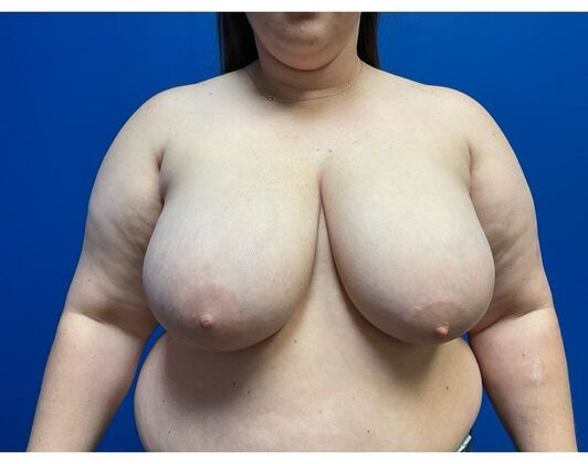 Breast Reconstruction Case 18 - Before