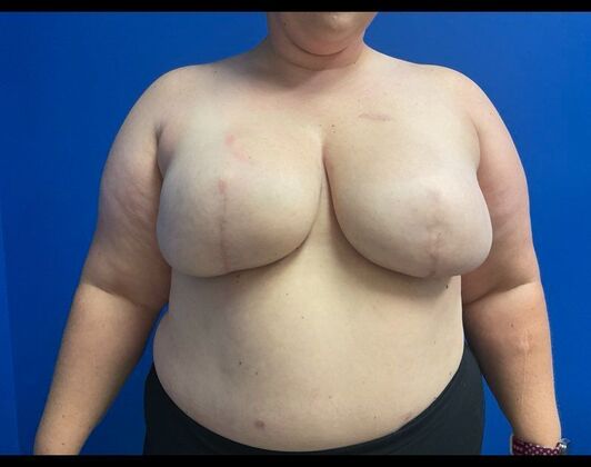 Breast Reconstruction Case 18 - After