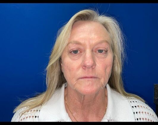 Facelift Case 18 - Before