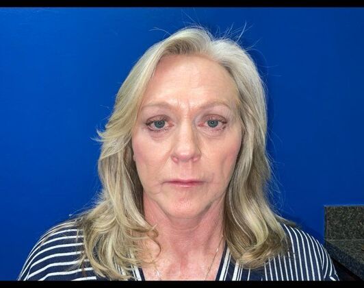 Facelift Case 18 - After