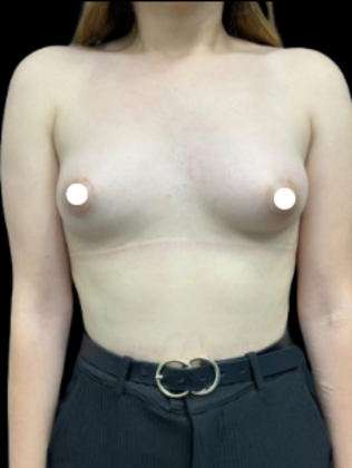 Breast Augmentation Breast Augmentation 6 - Before