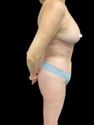 Mastopexy: Case 1 - After