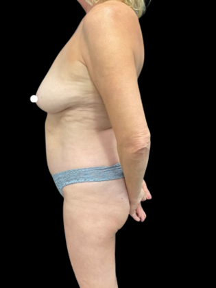 Mastopexy: Case 1 - Before